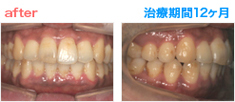 矯正治療 After