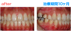 矯正治療 After